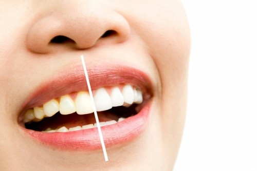 teeth-whitening-in-arlington023e55e1d81d3dd3.jpg