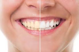 Teeth-Whitening-in-Arlingtonbc0cd4faf9e6461f.jpg