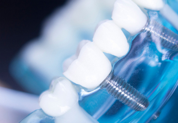 Emergency-Dentist-Montreal-West-Island9b5ed3a08a0e5213.jpg